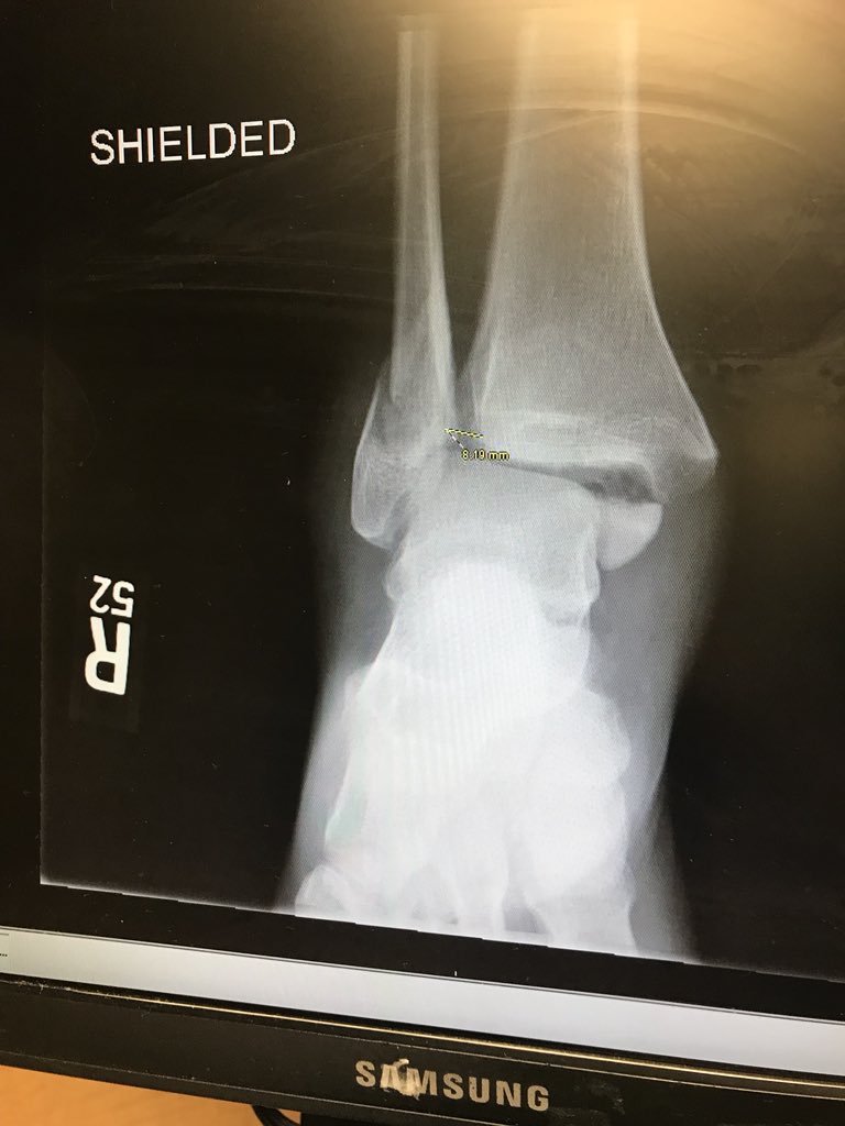 craigg107's tweet photo. Interesting weekend as I broke my tibia, fibula, and talus. Beyond thankful for @megan225hurst for taking care of me and even holding my hand the whole time as they tried to pop my ankle back in place. Now just ready for surgery so my foot will be connected back to my leg. https://t.co/zwksOZitCF