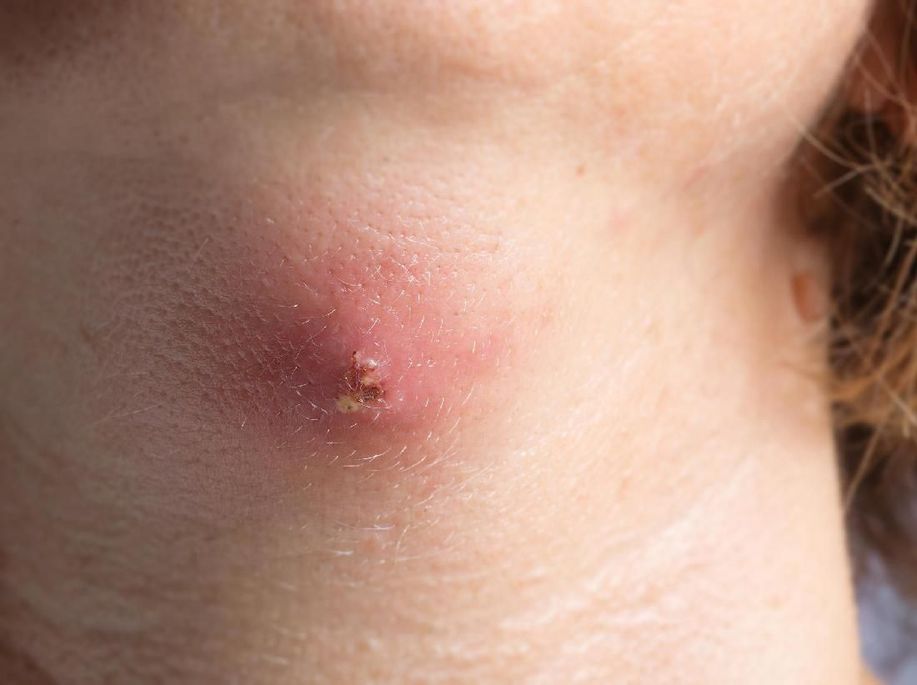 Australia Waspadai Epidemi Bisul Pemakan Daging  detik.id/6hvBZa via <a href="/detikHealth/">detikHealth</a>