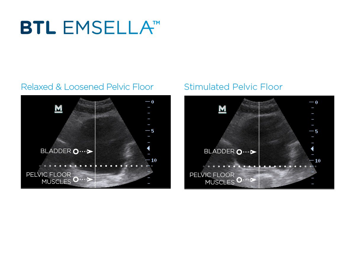 Btl Aesthetics Int On Twitter Weak Pelvic Floor Muscles May