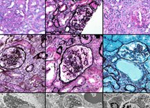 Ped_Neph's tweet photo. π COQ2 nephropathy: a treatable cause of nephrotic syndrome in children
https://t.co/5d2ryCXJay
Shareable link: https://t.co/ouXXW7oRLz
@seattlechildren @mcstarr1 @UWMedicine @UWNephrology @UW @CUAnschutz
#COQ2 https://t.co/D6KHjGUEph