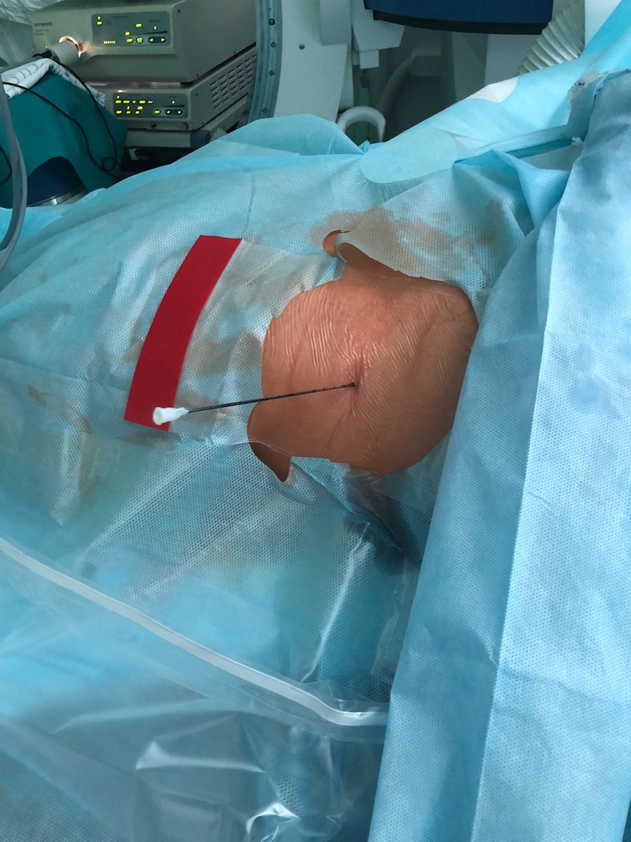 PolyDiagnost's tweet photo. Dr. Alexey Emelyanenko also showed his outstanding expertise in percutaneous operation with MicroPerc(R). https://t.co/H1f3CLZ0vM