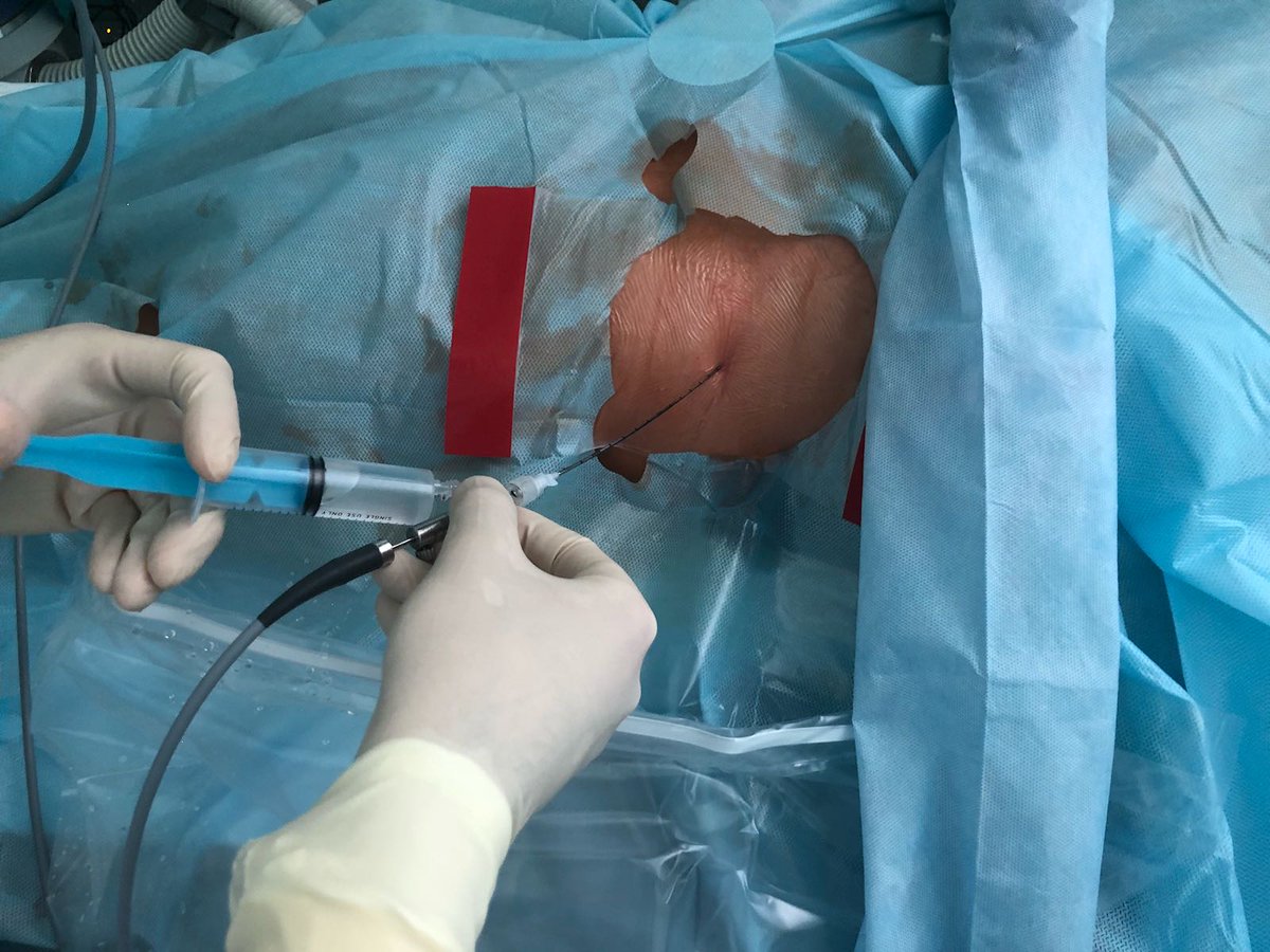 PolyDiagnost's tweet photo. Dr. Alexey Emelyanenko also showed his outstanding expertise in percutaneous operation with MicroPerc(R). https://t.co/H1f3CLZ0vM