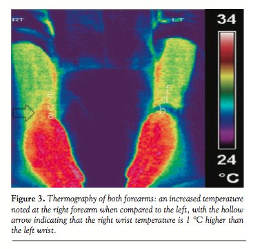 #Thermography can be a great diagnositic tool when working with #CRPS patients.  
#IHDI #ChronicPain #TreatmentOptions #Health #PainManagment #Hope