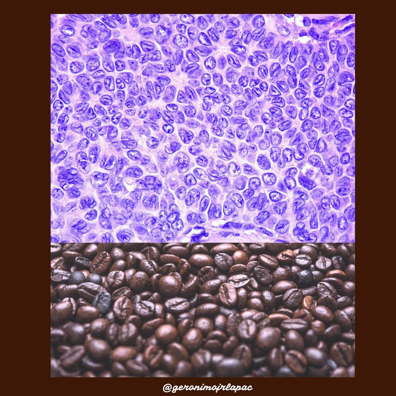 GeronimoJrLapac's tweet photo. A beaultiful case of granulosa cell tumor.
#Gynpath #pathology https://t.co/PJb0viEn9x