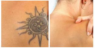 TheBQETweets's tweet photo. Tattoo Removal - Natural Tattoo Removal New York City

https://t.co/UTZo8WVfzG

#tattoo #tattooremoval #tattooart #tattoos #natural #naturaltattooremoval #health #beauty #fitness #nyc #newyorkcity #newyork #brooklyn #queens #statenisland #longisland #bronx #manhattan #thebqe https://t.co/4VNwmLs974