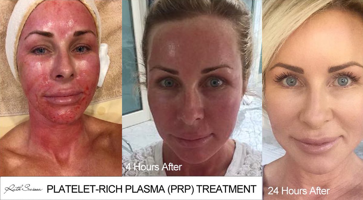plasma facial