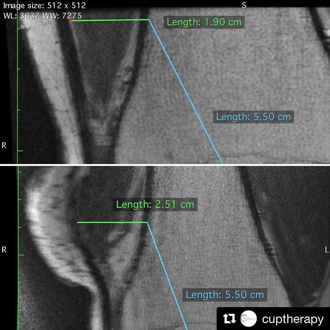 thebowtiePT's tweet image. #mindblownmondays 🤯with this T1 weighted image of extensibility of the ITband at the distal end of the femur. Only ~25% distortion of the tissue with MFD(bottom image) 🤔compared to preTx(top) #whatthecup #makingmarks #itsscience @CupTherapy