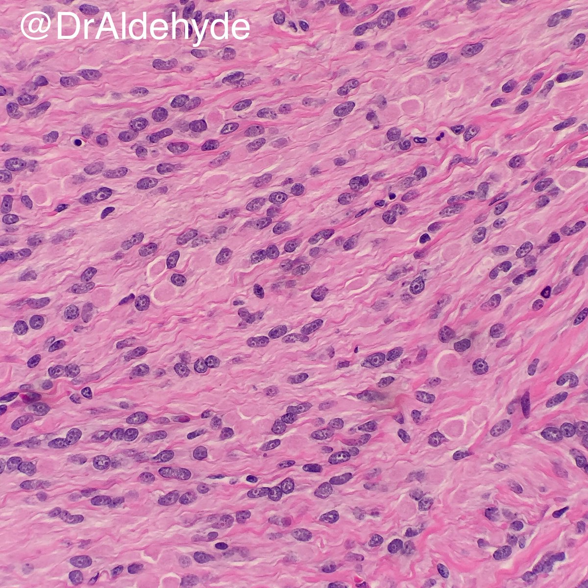 Woo Cheal Cho, MD (@draldehyde) on Twitter photo HPC-like vascular pattern + inclusion-like nucleoli + eosinophilic cytoplasmic globules = consider FH-deficient leiomyoma 🔬#GYNPath
<a href="/VijayPatho/">Vijay Shankar S</a> @bansar_bansaria <a href="/kriyer68/">Kalyani Bambal</a> <a href="/smlungpathguy/">Sanjay Mukhopadhyay</a> <a href="/BinXu16/">Bin Xu</a> <a href="/pembeoltulu/">Pembe Oltulu, MD</a> <a href="/luishcruzc/">Luis Humberto Cruz C</a> <a href="/sam_albadri/">Sam Albadri, M.D., M.Sc.</a> <a href="/drsys02/">Sunil Swami. MD.</a> <a href="/mreyesm/">Miguel Reyes-Múgica</a> <a href="/NRiddleMD/">Nicole D. Riddle, MD, MSHI, FCAP (she/her)</a> <a href="/TheKarenPinto/">Karen Pinto DNB, FRCPath</a> HPC-like vascular pattern + inclusion-like nucleoli + eosinophilic cytoplasmic globules = consider FH-deficient leiomyoma 🔬#GYNPath
<a href="/VijayPatho/">Vijay Shankar S</a> @bansar_bansaria <a href="/kriyer68/">Kalyani Bambal</a> <a href="/smlungpathguy/">Sanjay Mukhopadhyay</a> <a href="/BinXu16/">Bin Xu</a> <a href="/pembeoltulu/">Pembe Oltulu, MD</a> <a href="/luishcruzc/">Luis Humberto Cruz C</a> <a href="/sam_albadri/">Sam Albadri, M.D., M.Sc.</a> <a href="/drsys02/">Sunil Swami. MD.</a> <a href="/mreyesm/">Miguel Reyes-Múgica</a> <a href="/NRiddleMD/">Nicole D. Riddle, MD, MSHI, FCAP (she/her)</a> <a href="/TheKarenPinto/">Karen Pinto DNB, FRCPath</a>