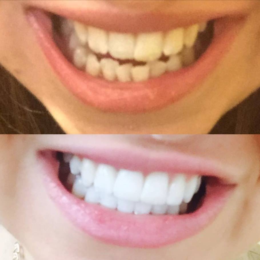 If you missed orthodontics as a child, don't worry it's still possible to have perfectly straight teeth - without the need for obtrusive 'train-track' braces. 

We provide <a href="/smilelign/">Smilelign®</a>  invisible aligners that achieve amazing results! 
For more info: chequersds.com/cosmetic-ortho…