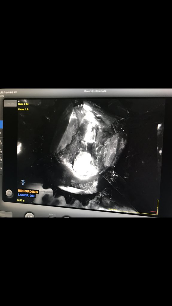 kuncoro202's tweet photo. Novodac SPY fluorescence for assessing bulbospongiofibrotic in urethral reconstructive surgery. #GURS #MCUE #inagurs https://t.co/2ekp1SycKF