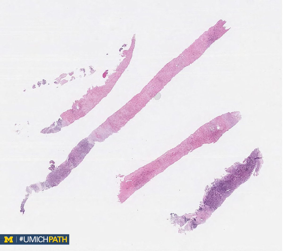 Michigan Pathology tweet media