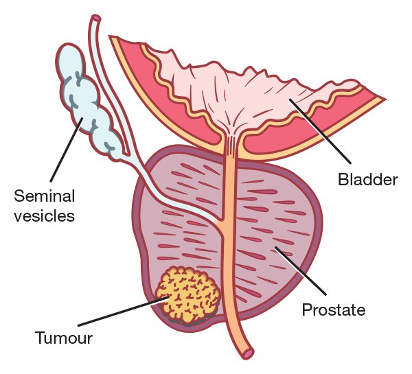 ManelEsteller's tweet image. Helping to identify #epigenetic defects in #noncoding #RNA associated with the development of #prostate #cancer, our collaboration with Dr Jeronimo is published in Clinical Epigenetics @BioMedCentral ow.ly/iq9U30jkTp0