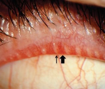 aepitrop's tweet photo. Blocked #meibomian glands are the leading cause of #dryeye. Contact our #DryEyeCenter of #Execellence 1-800-964- 9969 to examine, express and unblock your glands. https://t.co/hw2IaKhqG1