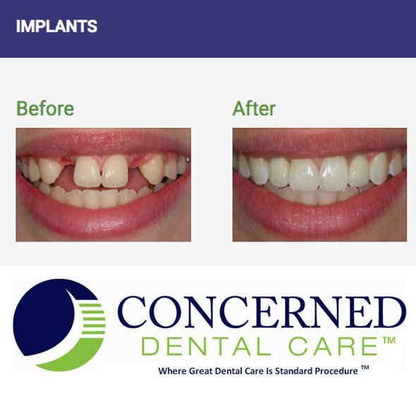 cdcmanhattan's tweet photo. Great smile… healthy teeth! Our first priority is your overall dental health. You may just need a scheduled cleaning and an exam – or you might need an implant or a root canal. Either way, we will provide you with the best treatment available.
#Implants #dental #dentist https://t.co/ZsgLdcnUEX