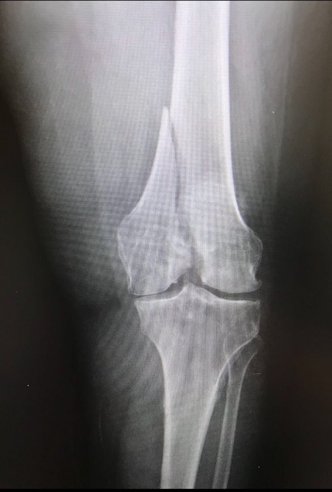 Patient presented with knee pain...I bet you did, bud 😬 #girlmedtwitter #womeninmedicine #ortho