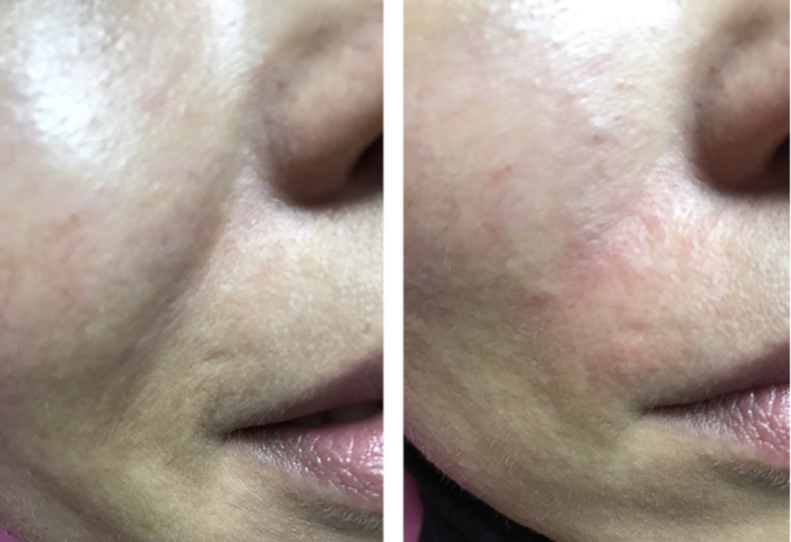 RadiantFiller's tweet photo. Our radiant fillers with give your client the results they want. We have a selection of different anti-wrinkle products and fillers which will help smooth and fill any lines and wrinkles. This picture shows the results you can expect. https://t.co/Pb3s7XEfTm
