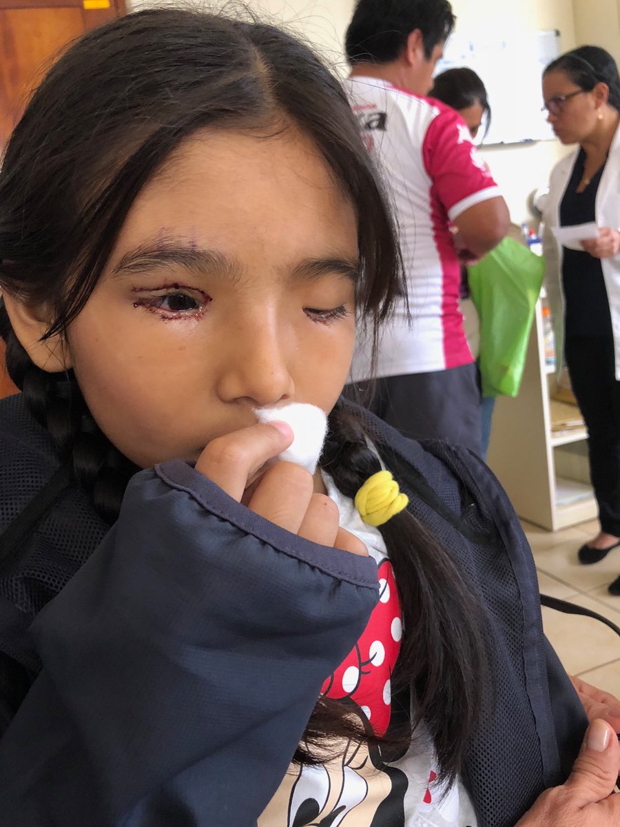 slmacneil's tweet photo. Bandages removed on Wednesday!  Amazing difference thanks to Dr Martha Arango @OrbisIntl #FlyingEyeHospital. So lucky for this experience! #IdeasBornToFly @UTCAeroSystems https://t.co/jXmKygxmWv