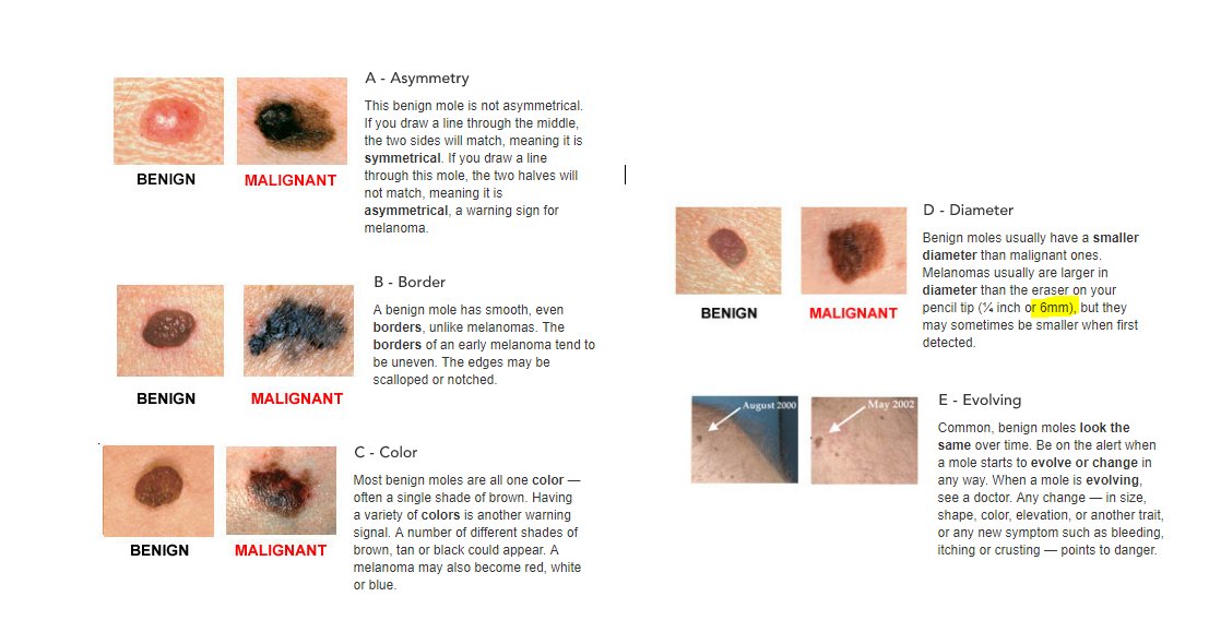 Med432's tweet photo. ABCDEs for melanomas #Med432 #Med434 https://t.co/GvFf1KgvVK
