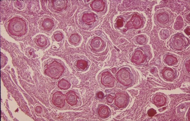 CaseyWallerSPT's tweet photo. Meningiomas may be completely benign or result in headache, seizures, and progressive neuro deficits as a result of compression. Imaging is important to detect and resect in a timely manner! Here’s a microscopic image of a meningioma #Neoplasms #PT546week12 @juliehershberg https://t.co/y8Xs9oGtuK