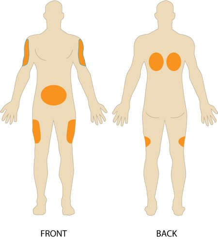 B12VitaminStore's tweet photo. What is a subcutaneous injection?
Subcutaneous injection is a method of injecting medication or vitamins. The method is used to inject substances between the skin and muscle, i.e. into the fatty tissue...
#b12Injection #b12shot #vitaminb12 #intramuscular
https://t.co/EeWfKWqYrM https://t.co/GWpR8qZnMv