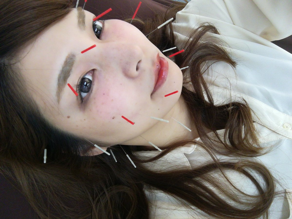 nanami_thej's tweet photo. やって来ました!2週に1回のメンテナンス✨
@medical_treeさん😊
顔の右側が下がっていたらしく引き上げてもらいました!
歪みにも効果的です\(^o^)/
#メディカルツリー
#medicaltree
#美容鍼
#小顔
#炭酸美容
#トラキャン
#トライハード
#クラブ
#tryhard https://t.co/sG1KxDKnw2