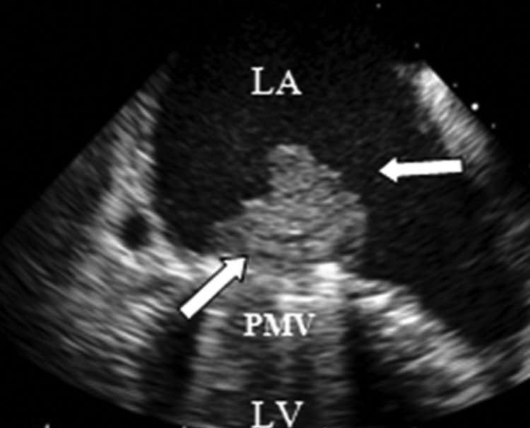 Cardiologyupda2's tweet photo. An important review of antithrombotic therapy in prosthetic valves; mechanical vs bio vs TAVR/mitaclip, newer mechanical designs+special circumstances: pregnancy, surgery, the bleeder, the recurrent emboliser
https://t.co/fbpDPYULMT https://t.co/nh6FHPhTZB