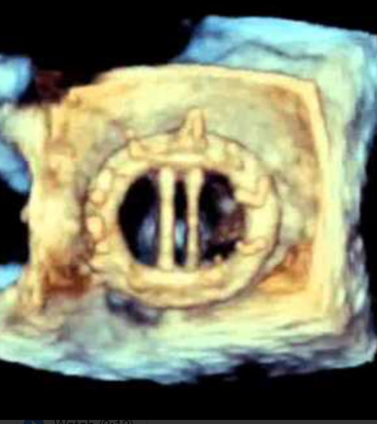 Cardiologyupda2's tweet photo. An important review of antithrombotic therapy in prosthetic valves; mechanical vs bio vs TAVR/mitaclip, newer mechanical designs+special circumstances: pregnancy, surgery, the bleeder, the recurrent emboliser
https://t.co/fbpDPYULMT https://t.co/nh6FHPhTZB