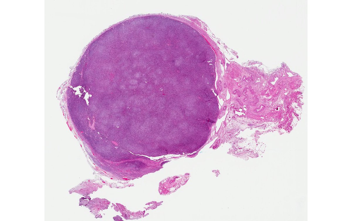 CPHpath's tweet photo. Friday @GynPath workout. 50 y/o with 3 cm solid ovarian mass. Inhibin &amp; calretinin ++. Reticulin shown. DDx cellular fibroma vs adult type granulosa cell tumor. Next step? https://t.co/eljjVDdGza