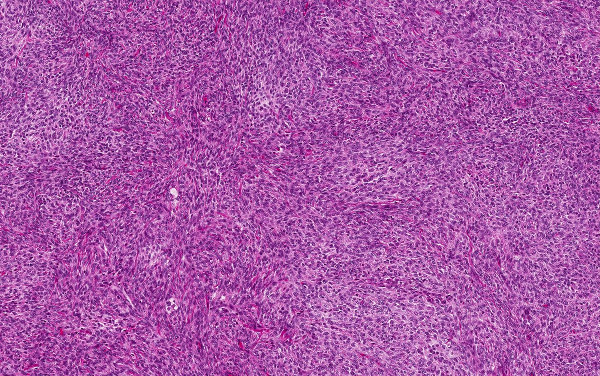 CPHpath's tweet photo. Friday @GynPath workout. 50 y/o with 3 cm solid ovarian mass. Inhibin &amp; calretinin ++. Reticulin shown. DDx cellular fibroma vs adult type granulosa cell tumor. Next step? https://t.co/eljjVDdGza