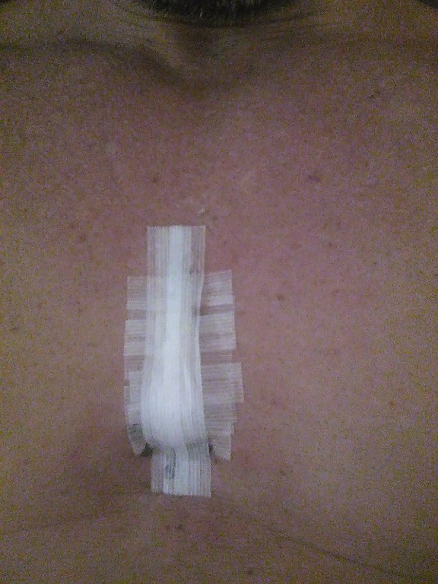 IvanDanXXX's tweet photo. Primer dia segundo dia de una operacion . Chic@s un consejo no tomeis rayos uva son malisimos para la.piel y pueden formar cancer es algo muy serio cuidaros. #lifeonlyone https://t.co/UhU6abAiL4