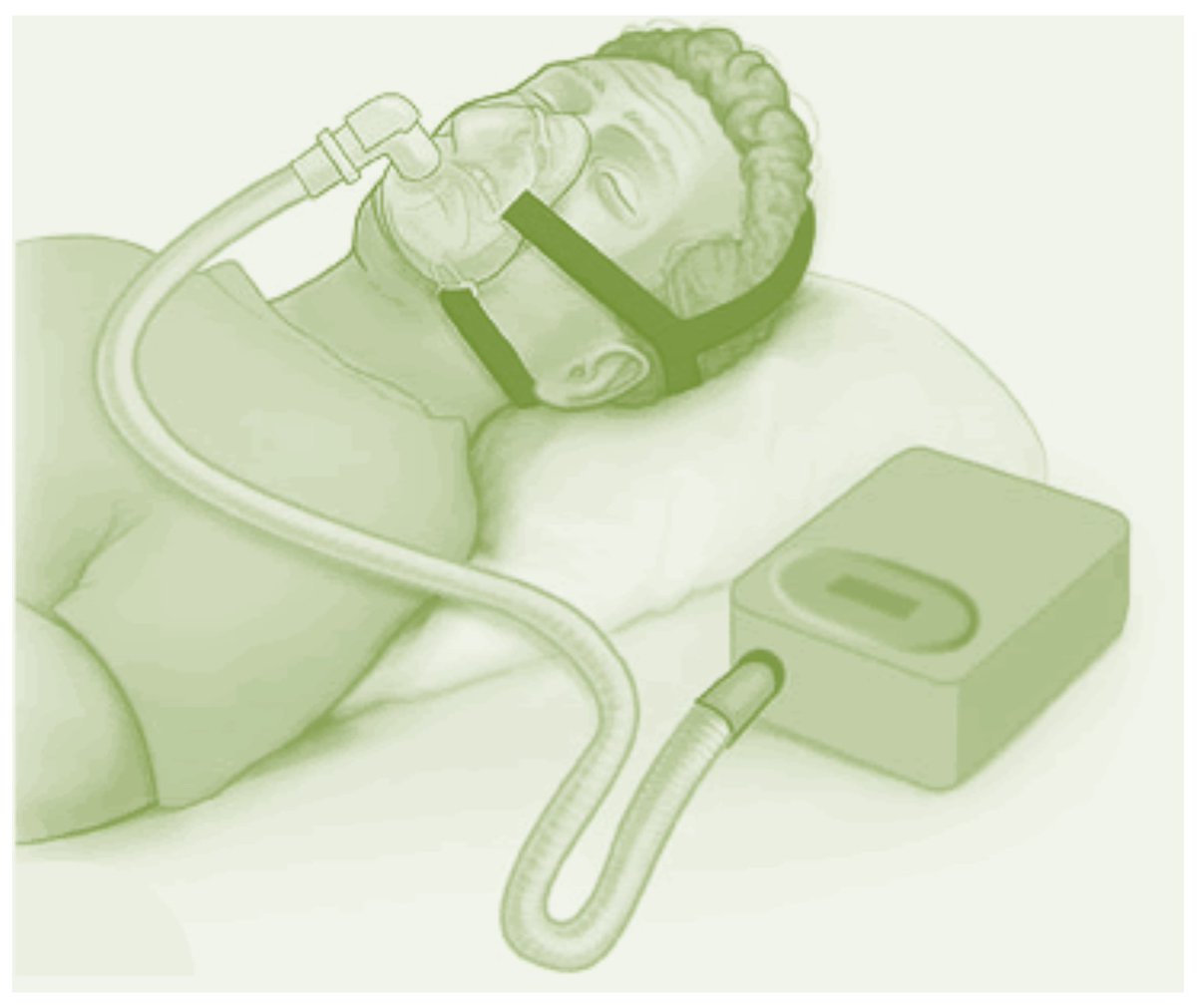 Netresp_com's tweet photo. Nous vous recommandons la lecture de notre 3ème article, qui expose de manière succincte les caractéristiques et av. principaux de la ventilation en #PPC => #Traitement efficace du syndrome d’#apnées obstructives du #sommeil. 
#ronflement #CPAP #médecine

https://t.co/usmE7WU4UZ https://t.co/mJRaXYPWVu
