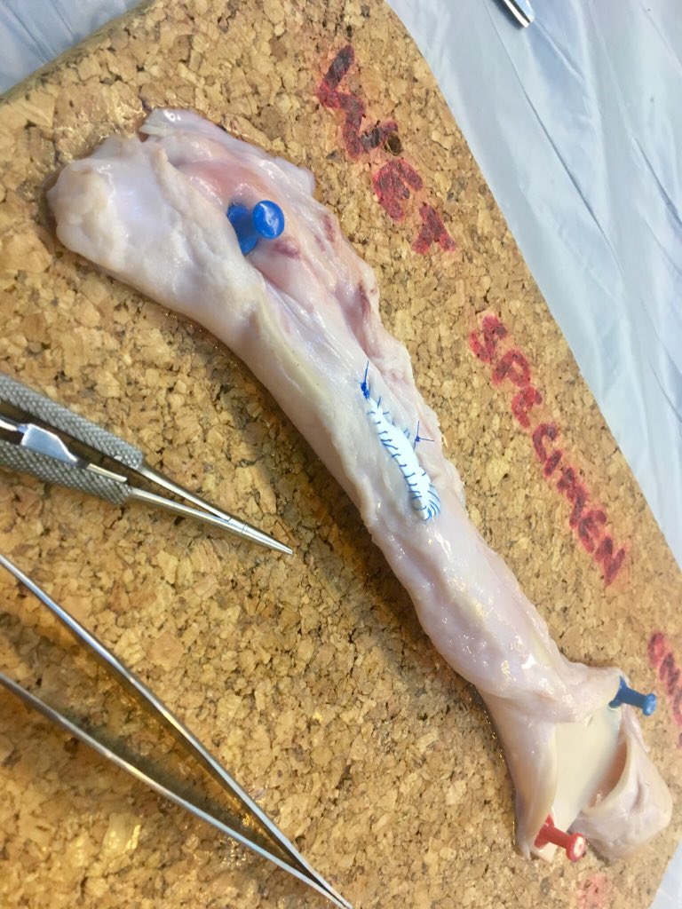 JamesAshcroftMD's tweet photo. My attempt at a carotid patch, thanks for the great teaching and session, looking forward to the conference weekend!#nurturingexcellence #ASiT2018 @ASiTofficial @DevMittapalli @RouleauxClub https://t.co/UHMRAdbuuT