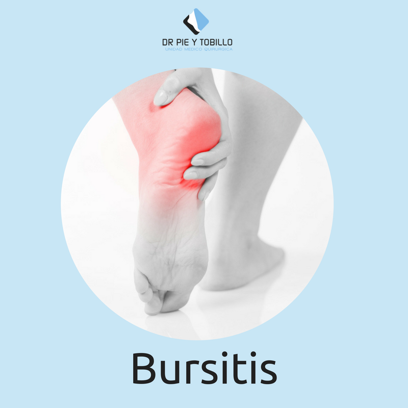 ¡Descubre qué es la bursitis en nuestra cuenta de Instagram! Ahí puedes encontrarnos como <a href="/drpieytobillo/">Unidad Pie y Tobillo</a> #6Abril