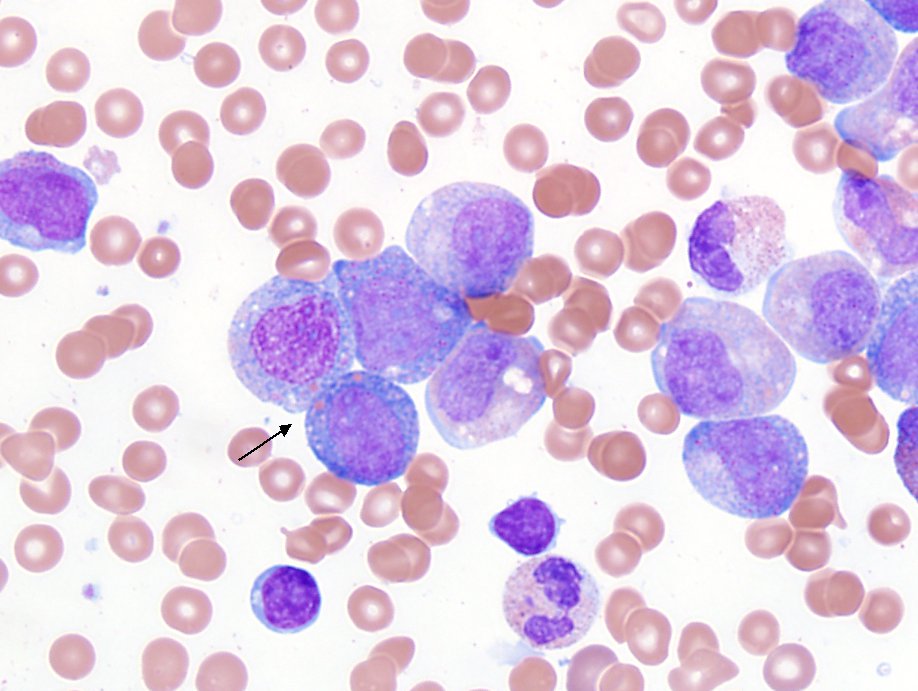 hematogones's tweet photo. Is trying to predict the AML translocation by morphology still a thing for #hemepath people? It's a 1 player game where you are always the winner.

Another myeloid sarcoma.

Salmon-colored granules/patches in granular blasts => associated with t(8;21) 

#pathboards #FOAMed https://t.co/vW3SXDC0UT