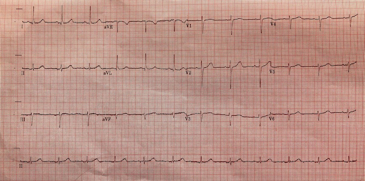 EPatPitt's tweet photo. Octogenarian w sympt PAF/RVR refractory to AADs. Nl LA size. I implanted His bundle pacer+did AVN RFA today. Nonselect His thresh 2V, muscle 0.5V. Who would have offered PVI first? @narrowQRS @Ed_Gerst @gopi_gdanda1 @sgreenbergmd @dredcronin @KrishKancharla @drjohnm https://t.co/dzFldcjaiq