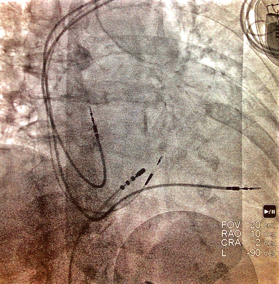 EPatPitt's tweet photo. Octogenarian w sympt PAF/RVR refractory to AADs. Nl LA size. I implanted His bundle pacer+did AVN RFA today. Nonselect His thresh 2V, muscle 0.5V. Who would have offered PVI first? @narrowQRS @Ed_Gerst @gopi_gdanda1 @sgreenbergmd @dredcronin @KrishKancharla @drjohnm https://t.co/dzFldcjaiq