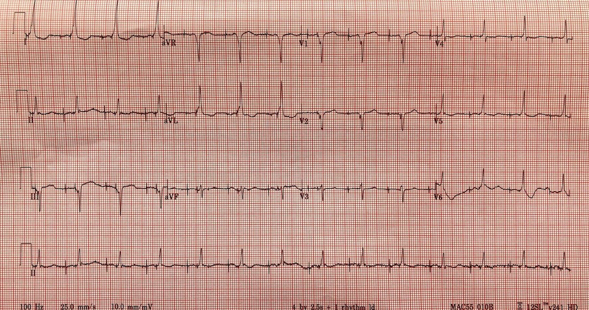 EPatPitt's tweet photo. Octogenarian w sympt PAF/RVR refractory to AADs. Nl LA size. I implanted His bundle pacer+did AVN RFA today. Nonselect His thresh 2V, muscle 0.5V. Who would have offered PVI first? @narrowQRS @Ed_Gerst @gopi_gdanda1 @sgreenbergmd @dredcronin @KrishKancharla @drjohnm https://t.co/dzFldcjaiq