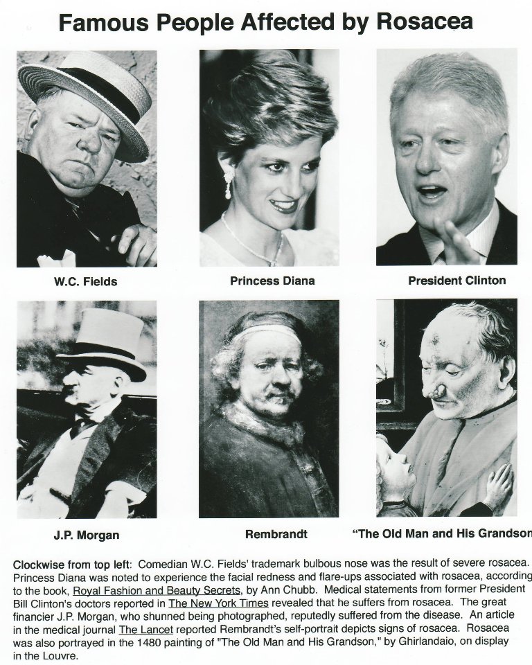berman_skin's tweet photo. A few famous faces affected by Rosacea
#RosaceaAwareness #Rosacea #typesofrosacea #facialredness #rosaceaawarenesssociety
Photo credit: National Rosacea Society https://t.co/ISXVmYAhcI