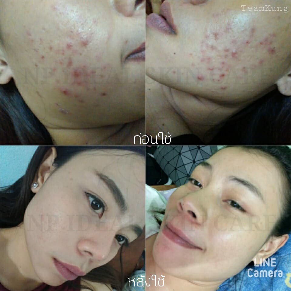Bell3992Bell's tweet photo. ส่องรีวิวเพิ่มเติมจากเฟสบุ๊คได้น๊า จบทุกปัญหาสิว ไว้ใจ #NPSKIN #ลดสิว #ใช้ดีบอกต่อ #สิวหาย https://t.co/f1dpjN8vzF