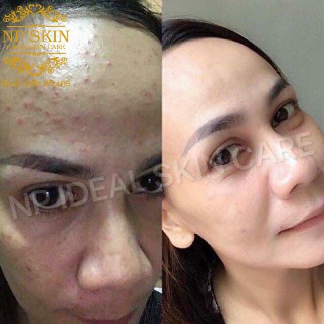 Bell3992Bell's tweet photo. ส่องรีวิวเพิ่มเติมจากเฟสบุ๊คได้น๊า จบทุกปัญหาสิว ไว้ใจ #NPSKIN #ลดสิว #ใช้ดีบอกต่อ #สิวหาย https://t.co/f1dpjN8vzF