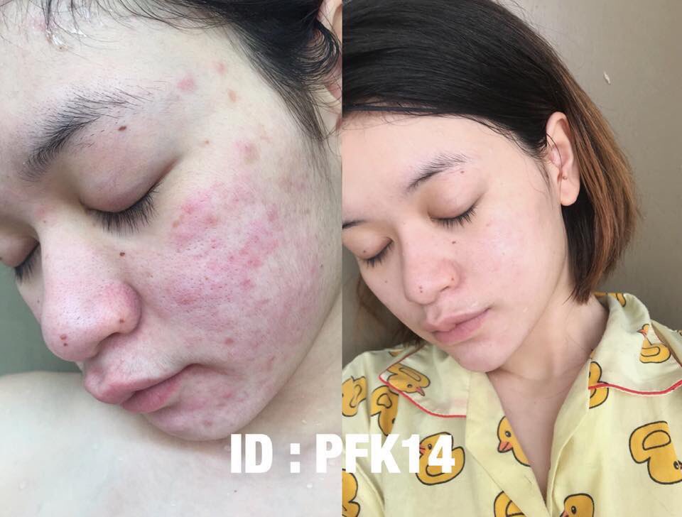 Bell3992Bell's tweet photo. ส่องรีวิวเพิ่มเติมจากเฟสบุ๊คได้น๊า จบทุกปัญหาสิว ไว้ใจ #NPSKIN #ลดสิว #ใช้ดีบอกต่อ #สิวหาย https://t.co/f1dpjN8vzF
