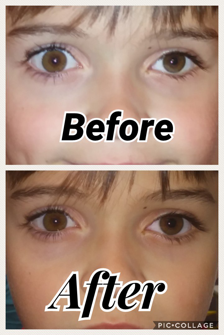 RBAZ_'s tweet photo. #Retinoblastoma survivor Tristen is excited to show off his new eye. https://t.co/WGrC4qnrSA