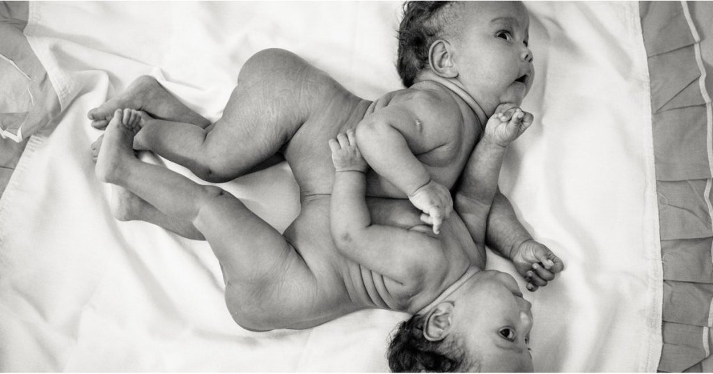 HealthBeauty747's tweet photo. A Photographer Captured Conjoined Twins Like You've Never Seen Them Before https://t.co/AaWyr6pE5c https://t.co/ZcGt5UVEh1