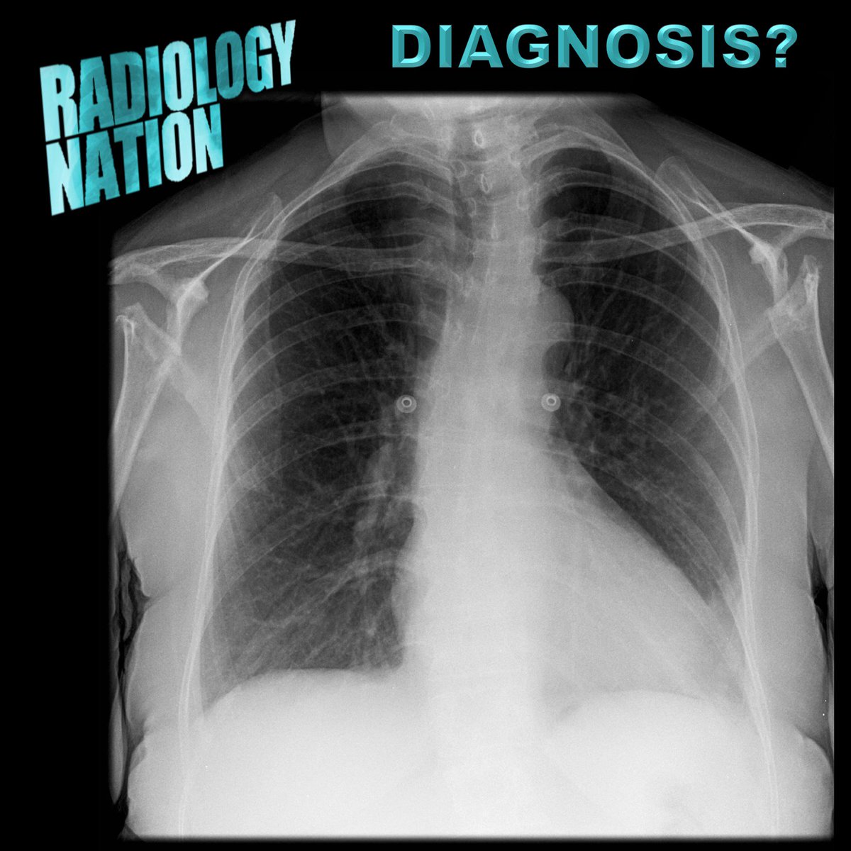radiologynation's tweet photo. Interesting #ChestRad case here - any #radreg/#radres 👨🏽‍⚕️👩‍⚕️ have a diagnosis (or differential) for us? #FOAMrad #FOAMed #MedEd #medicaleducation #radiology

🤔

Clue 👉🏼: #MSKrad https://t.co/WxfGWqy7hO