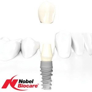 Ultrasmile_ru's tweet image. Акция дает право на полный комплекс услуг по восстановлению 1 зуба и коронковой части.
Гарантия на работу врача пож ...
is.gd/RqA63E
#UltraSmile #красиваяулыбка #зубы #зубнаяболь #стоматологии #лечениезубов #анестезия #зубнаяэмаль #здоровье #профилактика #питание