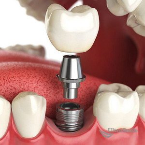 Ultrasmile_ru's tweet image. Заявка дает право на полный комплекс услуг по установке импланта Osstem, (Юж. Корея), абатмента и коронки из диокси ...
is.gd/Xg4Oec
#UltraSmile #красиваяулыбка #зубы #зубнаяболь #стоматологии #лечениезубов #анестезия #зубнаяэмаль #здоровье #профилактика #питание