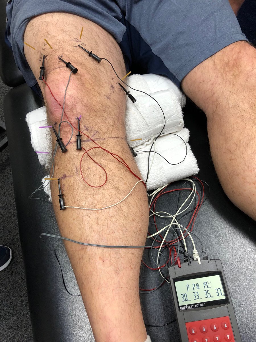 DrDunning's tweet photo. Periosteal electrical #dryneedling is an effective treatment for knee osteoarthritis, but it has nothing to do with pricking muscular TrPs. Improved articular vascularization, cartilage repair, inhibition of osteoclast activity, and inhibition of inflammatory cytokine release... https://t.co/5yuRz7C8y3