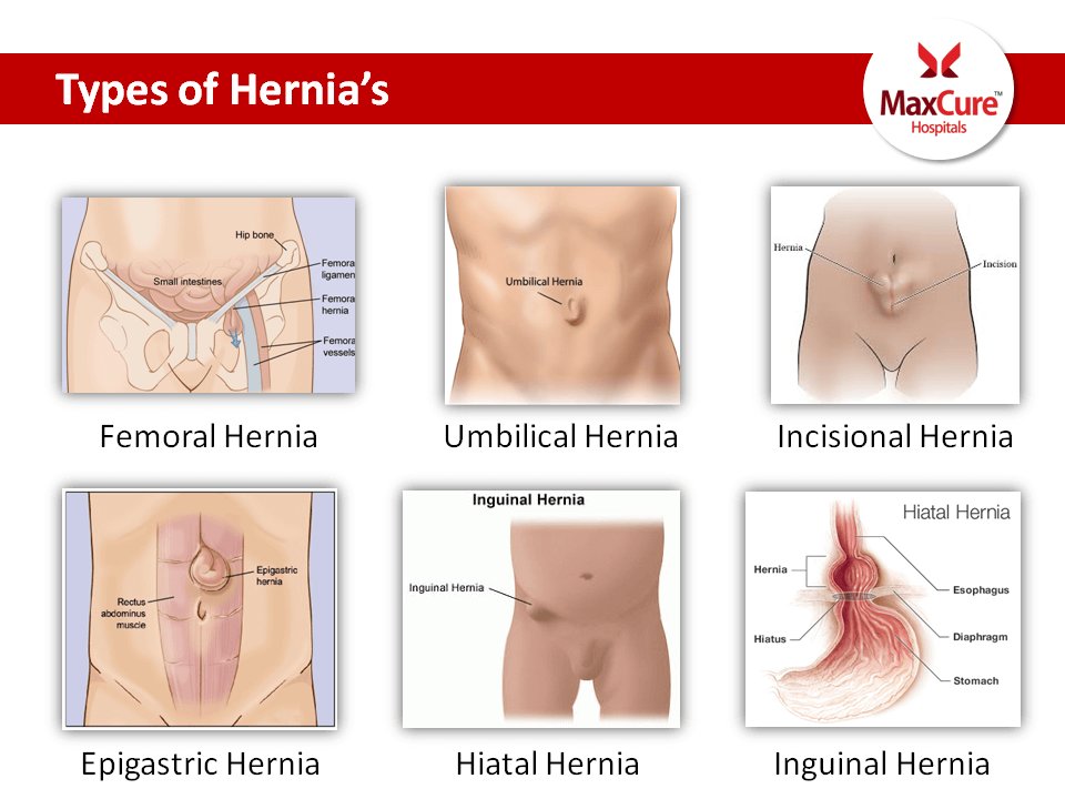 MedicoverIN's tweet photo. Overview about Hernia
Visit: https://t.co/UfgACVMC0t
#MaxCureHospitals #MaxCure #Hernia #Heavylifting #Vomiting #stomachpain #OPenSurgery #LaparoscopySurgery #Overweight #Highfever #Obesity #ConsultExperts #Hyderabad https://t.co/GtsWsi44d4