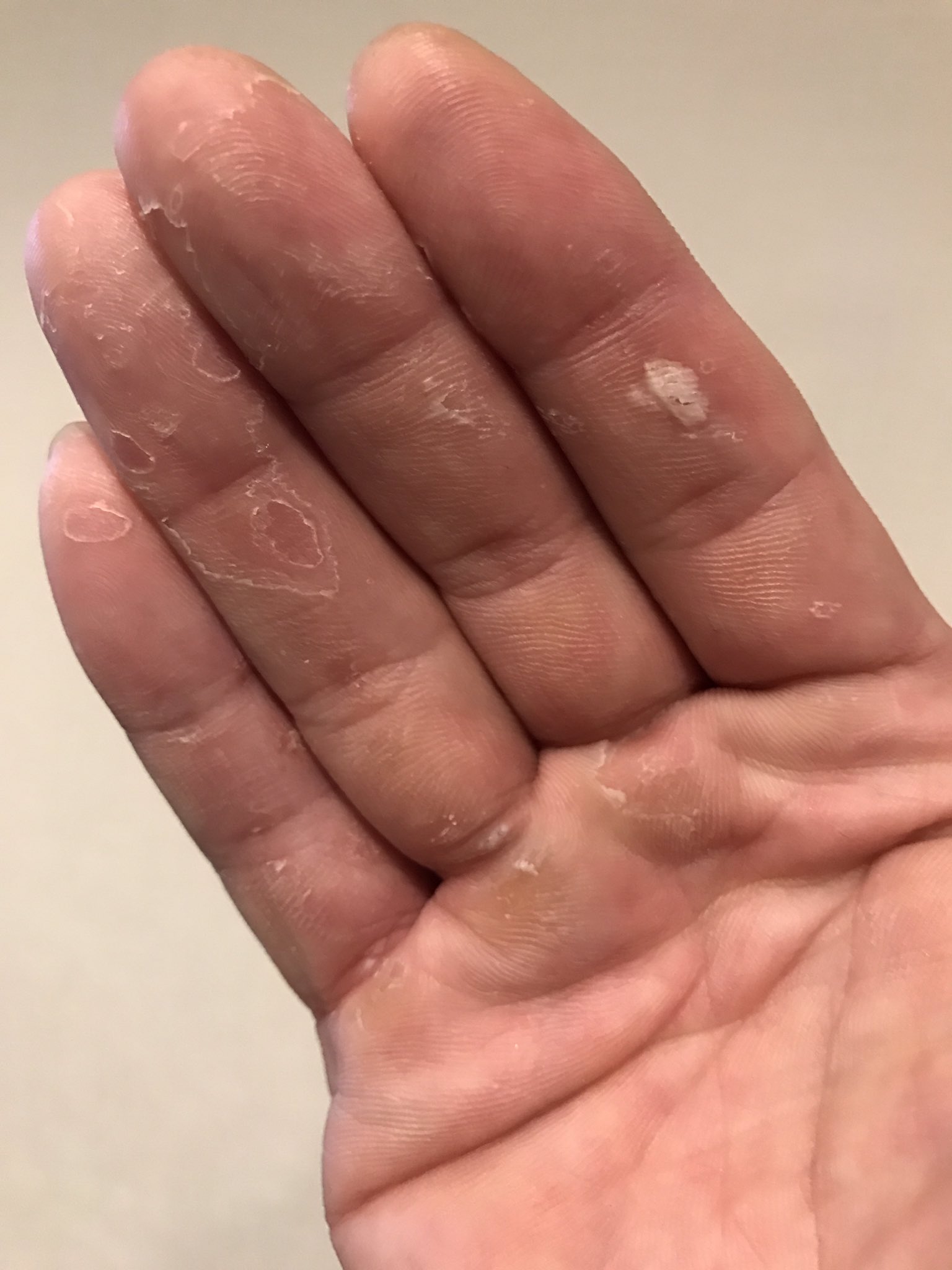 皮剥けた 皮が剥けた😭 | NOKOちゃんち