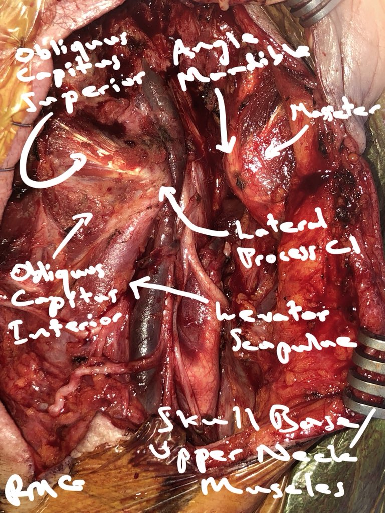 Anatomy in Action is back. These photos are of the skull base and upper neck following a tumour resection including the lateral temporal bone and styloid process. It’s taken me 3 textbooks to find the obliquus capitus superior and inferior #surgtweeting #headandneckcancer